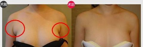 烦人的副乳应该如何消除呢 烦人的副乳应该如何消除呢