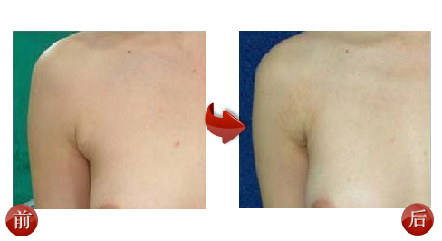 副乳整形效果前后对比 副乳整形效果前后对比