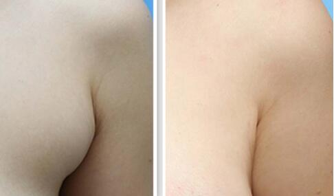 副乳吸脂手术怎么做的