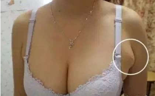 做副乳切除哪里最好 做副乳切除哪里最好