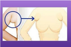 做副乳手术哪里最好 做副乳手术哪里最好