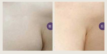 副乳整形后需要注意什么 副乳整形后需要注意什么