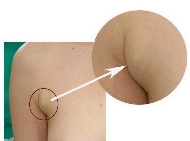 副乳切除术的效果到底怎么样