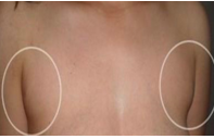 上海副乳矫正要多少钱 上海副乳矫正要多少钱