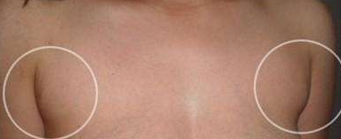 深圳做副乳切除要多少钱 深圳做副乳切除要多少钱