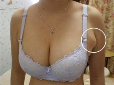 哪种副乳有癌变的可能吗 哪种副乳有癌变的可能吗