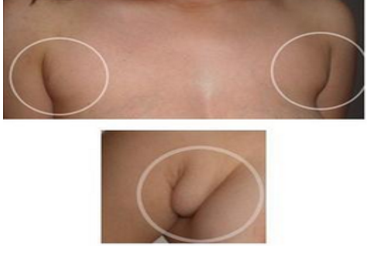 哪些因素影响了副乳切除价格