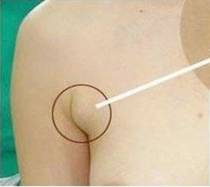 副乳切除怎么避免复发