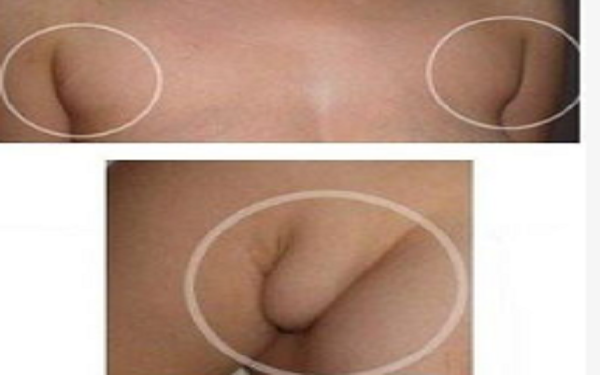 副乳的形成和切除手术介绍 副乳的形成和切除手术介绍