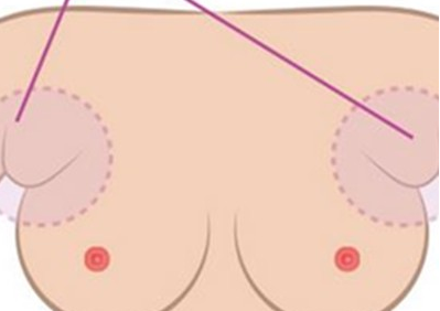 怀孕期间可以切除副乳吗 怀孕期间可以切除副乳吗