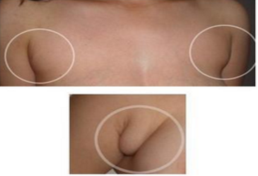 副乳切除方式是抽脂好还是切除好 副乳切除方式是抽脂好还是切除好