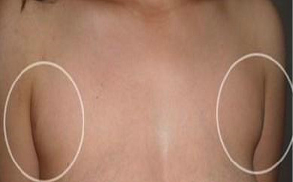 副乳切除术后有切口痕迹吗