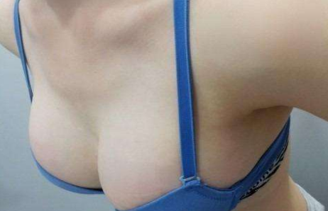 副乳切除会损伤腋下敏感神经吗 副乳切除会损伤腋下敏感神经吗