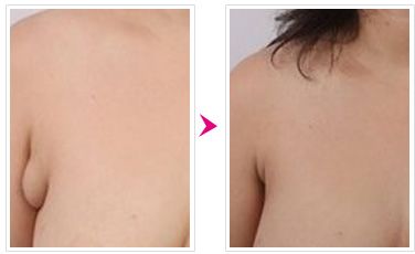 副乳切割手术多少钱 副乳切割手术多少钱