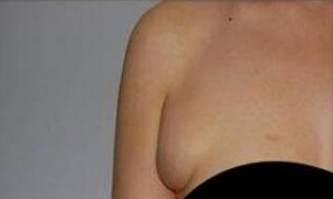 副乳切除术恢复需要很长时间吗 副乳切除术恢复需要很长时间吗