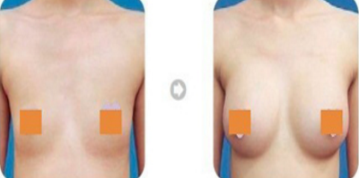 副乳切除术会导致皮肤萎缩吗 副乳切除术会导致皮肤萎缩吗