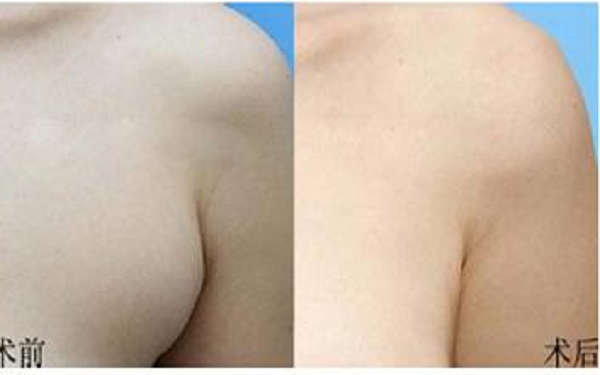 介绍副乳切除手术步骤 介绍副乳切除手术步骤