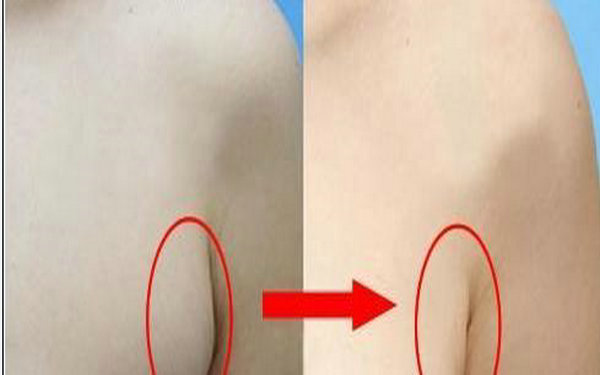 副乳切除手术原理及副作用 副乳切除手术原理及副作用