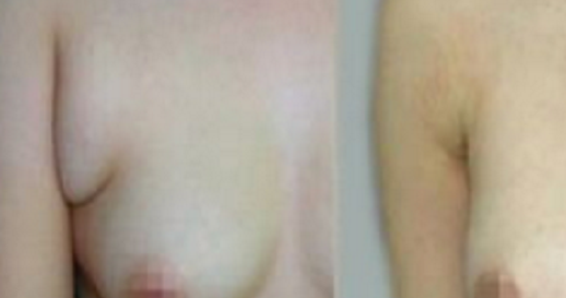 副乳切除在腋下的疤痕明显吗