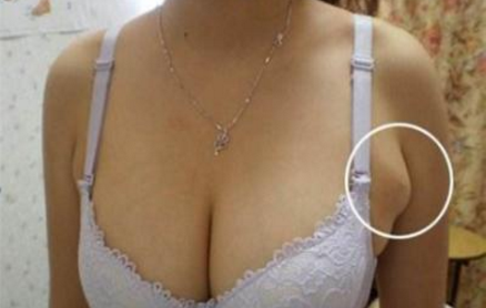 良好的副乳吸脂术后护理成就手术效果