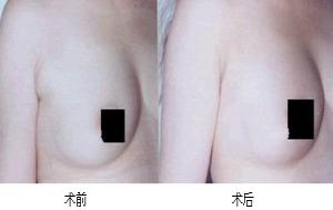 副乳切除的办法有哪些 副乳切除的办法有哪些