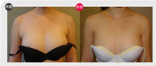 女性副乳哪种情况需要切除 女性副乳哪种情况需要切除