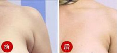 割副乳需要多少钱 割副乳需要多少钱