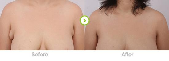 如何能判断出有副乳 如何能判断出有副乳