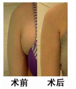 如何判断自己是否有副乳 如何判断自己是否有副乳