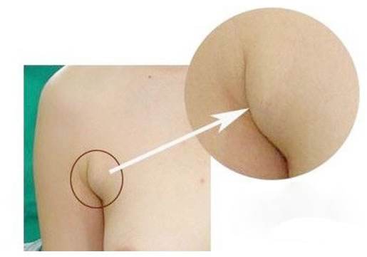 出现副乳怎么治疗 出现副乳怎么治疗