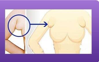 什么是副乳,副乳的图片 什么是副乳,副乳的图片