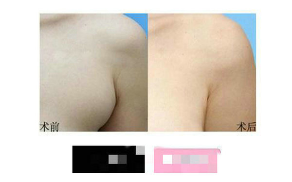 收副乳的常见误区有哪些? 收副乳的常见误区有哪些?