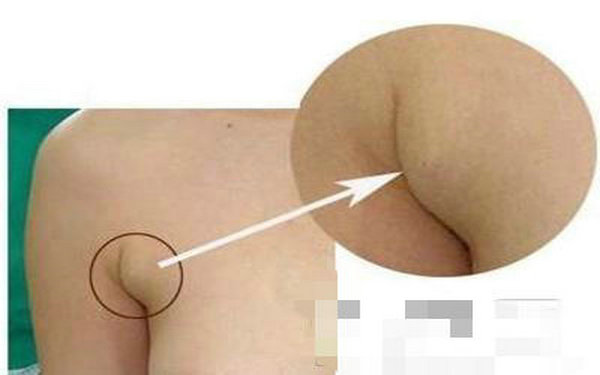 什么是副乳,副乳切除手术的步骤 什么是副乳,副乳切除手术的步骤