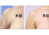 去除副乳的方法有哪些 去除副乳的方法有哪些