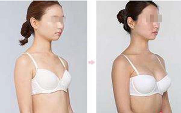 如何消除副乳 如何消除副乳