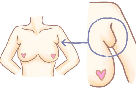 副乳长什么样子图片 副乳长什么样子图片