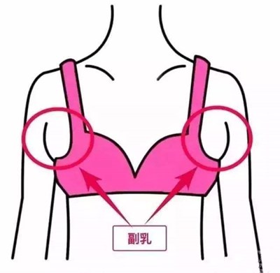 副乳长什么样子图片 副乳长什么样子图片