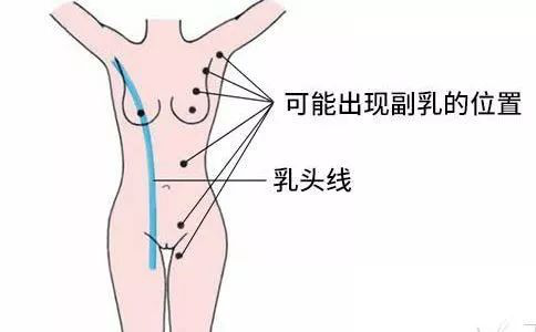 副乳长什么样子图片 副乳长什么样子图片