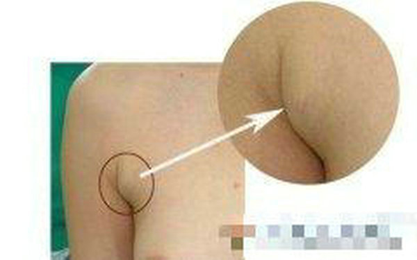 副乳切除多少钱? 副乳切除多少钱?