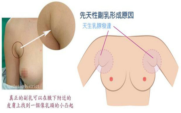 副乳手术需要住院几天 副乳手术需要住院几天