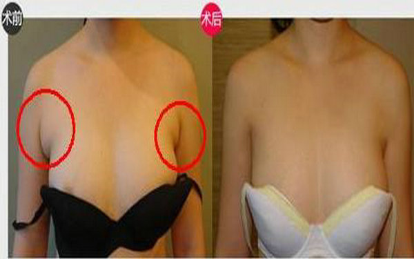 副乳手术前后对比图 副乳手术前后对比图