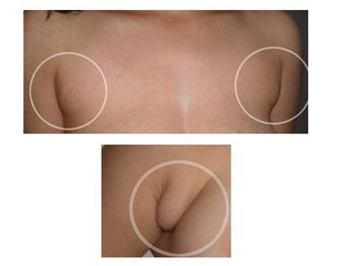 副乳的形成原因有哪些 副乳的形成原因有哪些