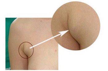 副乳切除的手术切口及优势如何 副乳切除的手术切口及优势如何