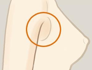 副乳切除的手术过程及适合人群 副乳切除的手术过程及适合人群