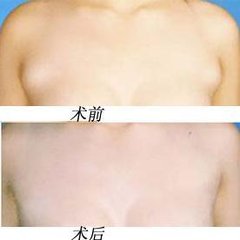 副乳切除的禁忌人群及副作用 副乳切除的禁忌人群及副作用