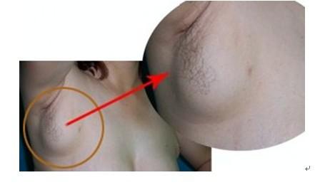 副乳形成的原因,副乳切除注意事项 副乳形成的原因,副乳切除注意事项