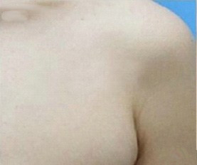 副乳吸脂的禁忌人群及术后恢复