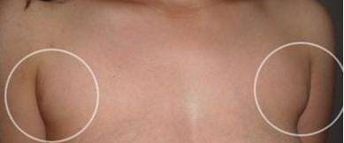 副乳是怎样形成的 副乳是怎样形成的