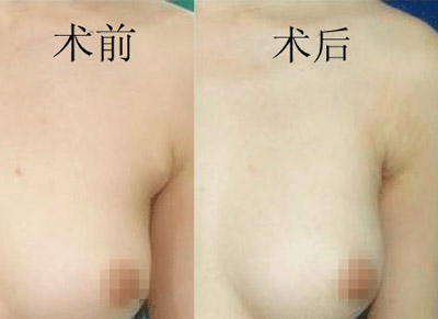 副乳切除复杂吗,手术有哪些要点