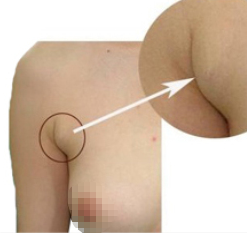 副乳形成的原因和副乳切除的副作用 副乳形成的原因和副乳切除的副作用